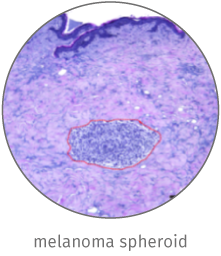 Melanoma skin cancer model illustration