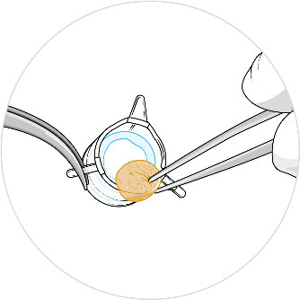 Analysis of NativeSkin® human skin biopsy