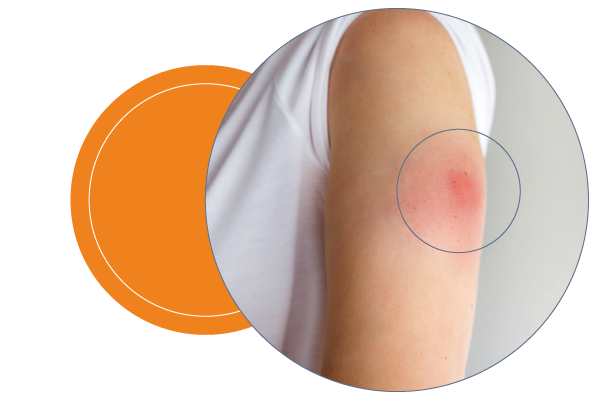 Injection Site Reaction